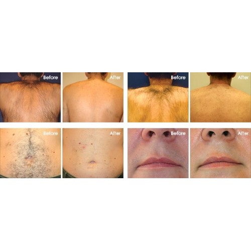 Teach you how to distinguish 808 hair removal instrument: micro channel, macro channel, no channel