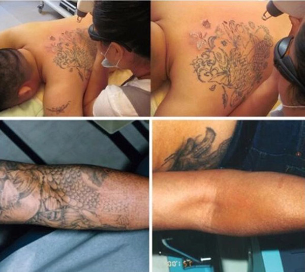 Máquina de eliminación de tatuajes con láser Nd Yag