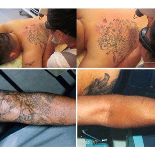 Nd Yag Laser Tattoo Removal Machine