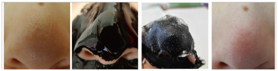 Blackhead removal strip