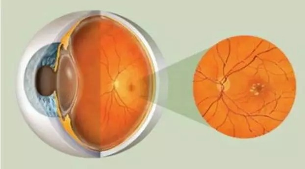 Age-Related Macular Degeneration (AMD)