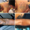 Máquina de eliminación de tatuajes con láser Nd Yag