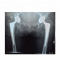 Manufacture of titanium hip prosthesis femoral stem for total hip replacement