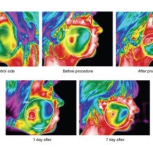 Application and Development of Infrared Thermal Imaging Cameras in Laser Plastic Surgery