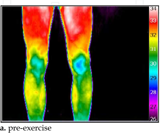 How is Infrared Thermal Imaging Technology Applied in the Field of Sports Rehabilitation?