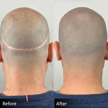 Structured SMP Scalp Micropigmentation Pigment System with Color Correction (Orange & Brown Modifiers) | CharmingTattoo PMU Manufacture