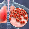 Heavy weight! The first domestic product! Zhifei Biotechnology's application for the launch of the 15 valent pneumonia vaccine has been accepted, benchmarking against Merck PCV15!