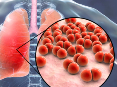 Heavy weight! The first domestic product! Zhifei Biotechnology's application for the launch of the 15 valent pneumonia vaccine has been accepted, benchmarking against Merck PCV15!