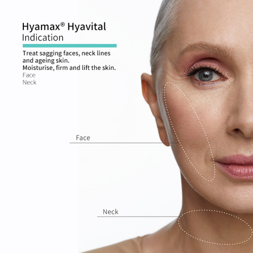 Hyamax® Hyavital Hyaluronic Acid Face Fillers، Dermal Fillers Brands