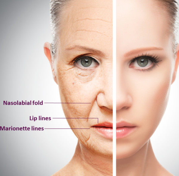 Um guia para preenchimentos dérmicos injetáveis