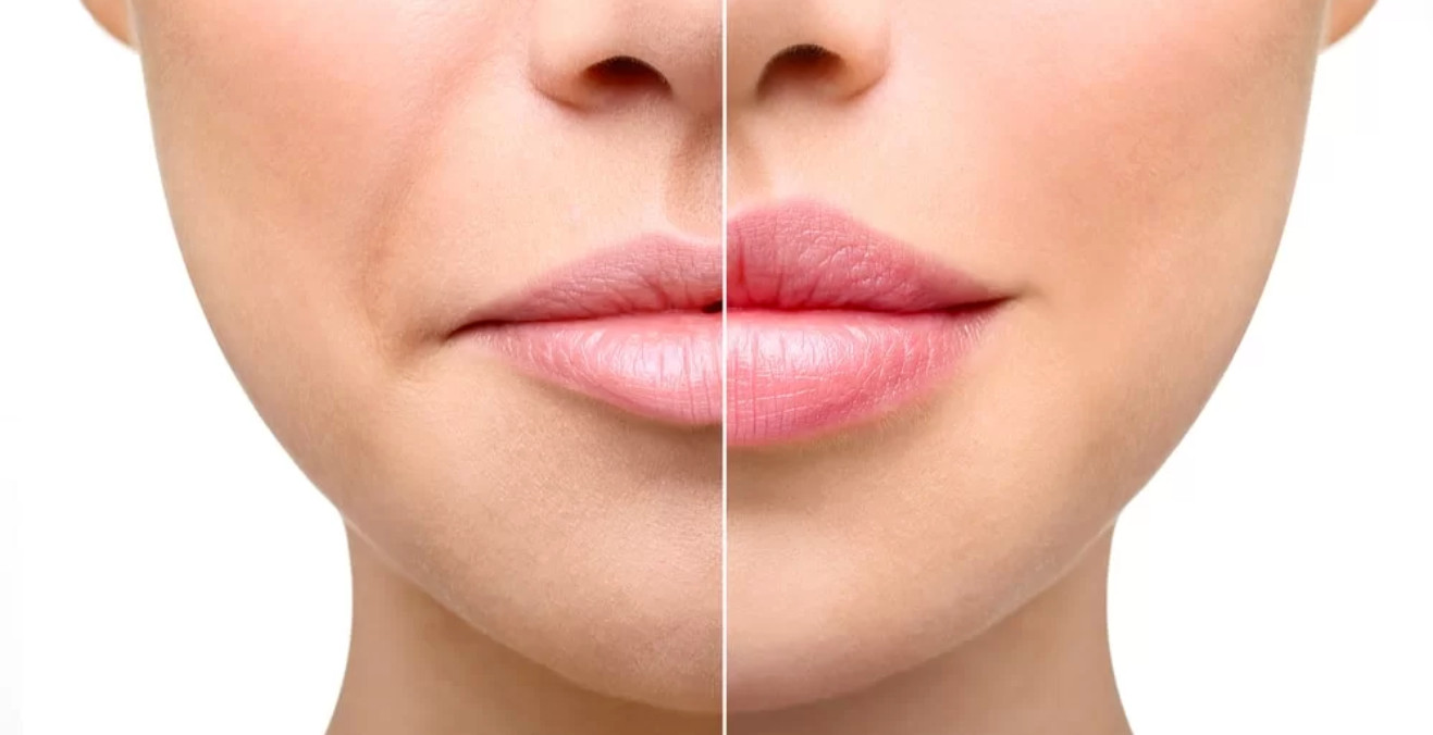 Lip Fillers