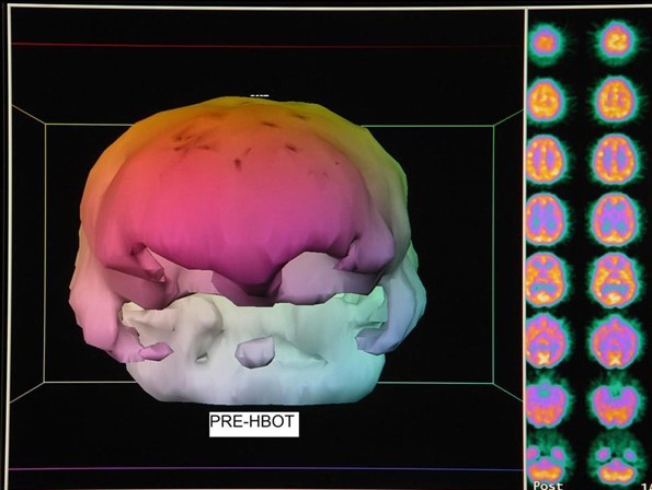 Low pressure hyperbaric oxygen therapy and SPECT brain imaging in the treatment of blast-induced chronic traumatic brain injury (post-concussion syndrome) and post traumatic stress disorder: a case report