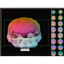 Low pressure hyperbaric oxygen therapy and SPECT brain imaging in the treatment of blast-induced chronic traumatic brain injury (post-concussion syndrome) and post traumatic stress disorder: a case report