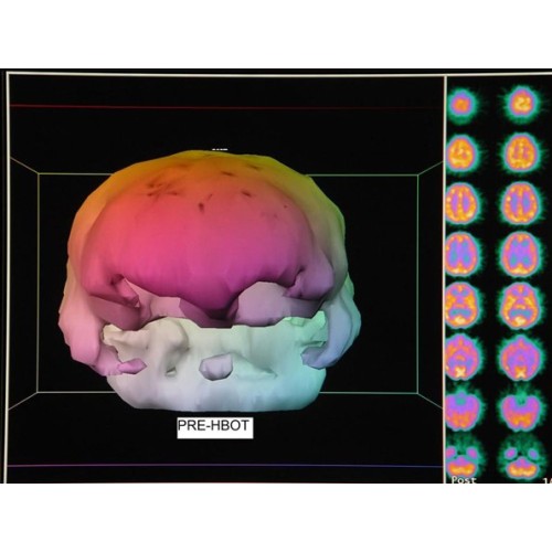 Low pressure hyperbaric oxygen therapy and SPECT brain imaging in the treatment of blast-induced chronic traumatic brain injury (post-concussion syndrome) and post traumatic stress disorder: a case report