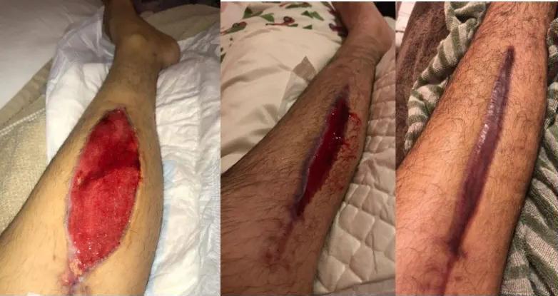 Slow Healing Wound Recovery with Hyperbaric Therapy
