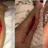 Slow Healing Wound Recovery with Hyperbaric Therapy