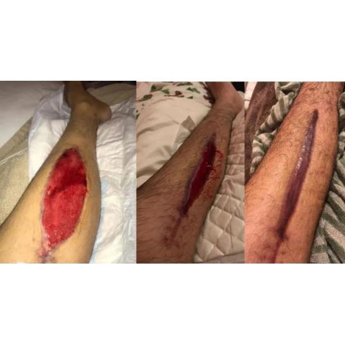 Slow Healing Wound Recovery with Hyperbaric Therapy