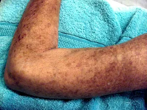 The Effect of Hyperbaric Oxygen on Scleroderma