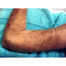 The Effect of Hyperbaric Oxygen on Scleroderma