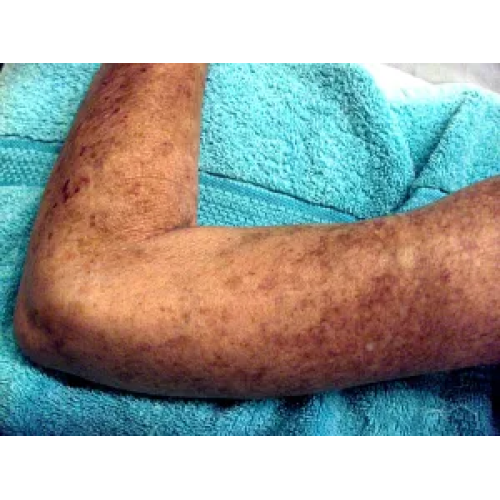 The Effect of Hyperbaric Oxygen on Scleroderma