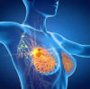 Hyperbarics For Breast Cancer Radiation Tissue Toxicity