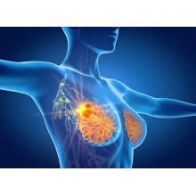 Hyperbarics For Breast Cancer Radiation Tissue Toxicity