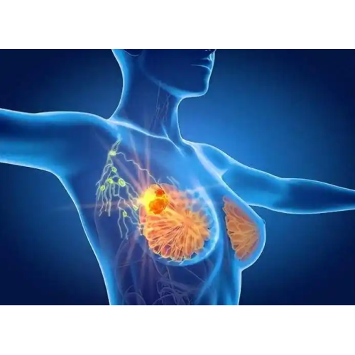 Hyperbarics For Breast Cancer Radiation Tissue Toxicity