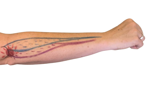 Pain location in Tennis Elbow
