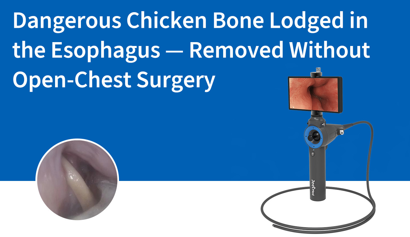 Dangerous Chicken Bone Lodged in the Esophagus — Removed Without Open-Chest Surgery
