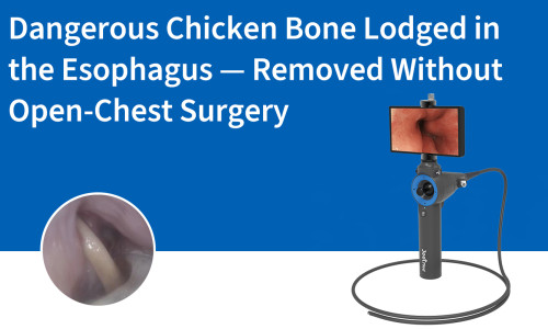 Os de poulet dangereux logé dans l'œsophage — Retiré sans chirurgie à thorax ouvert