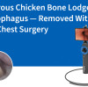 Dangerous Chicken Bone Lodged in the Esophagus — Removed Without Open-Chest Surgery