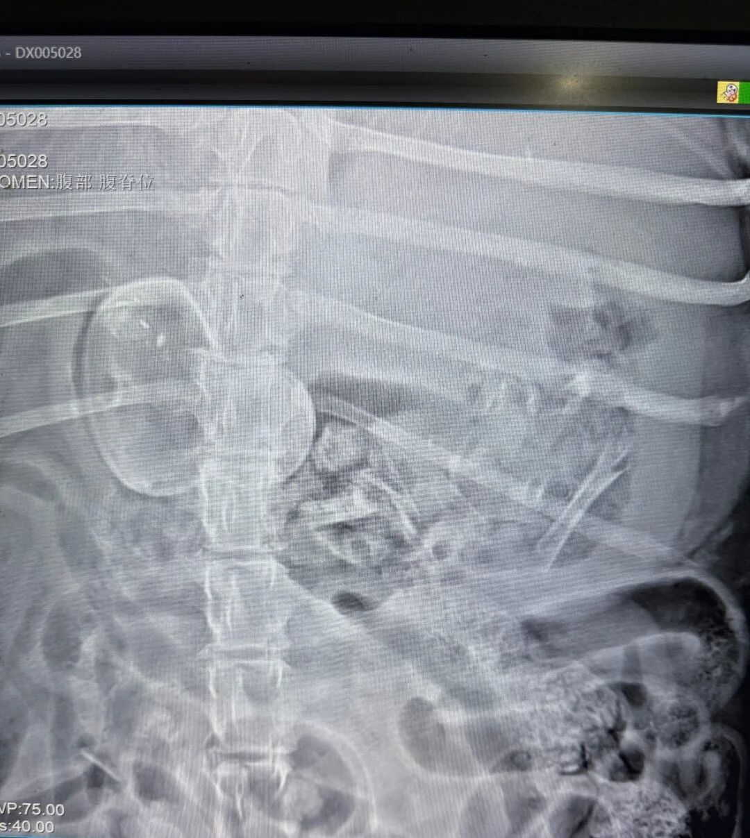 The pig underwent a successful gastroscopic examination using JeetVet’s advanced  Veterinary Endoscope.