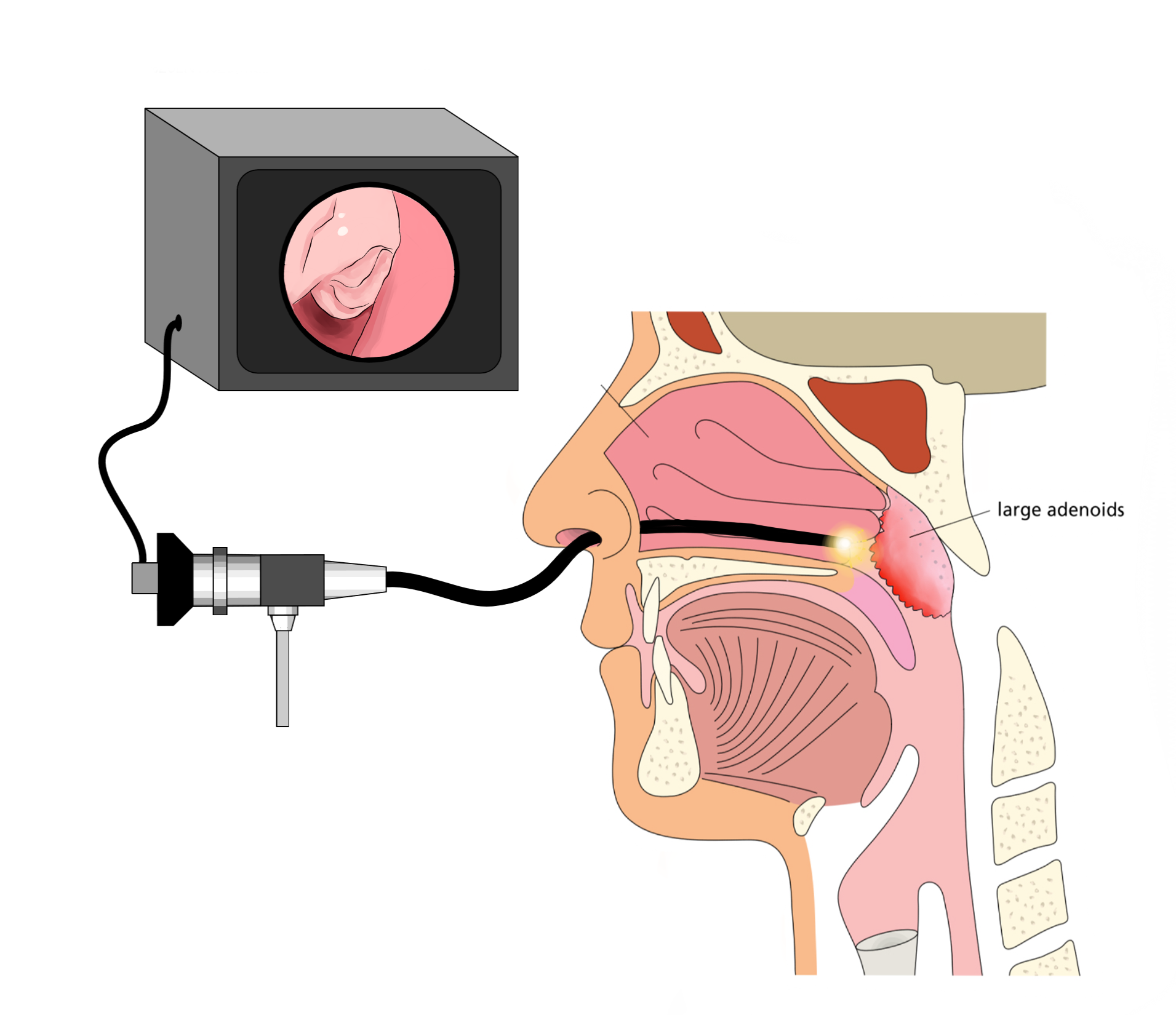 Adenoids with endoscopy