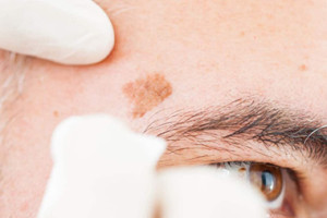 Tratamiento con nitrógeno líquido