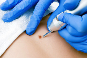 Liquid Nitrogen Treatment