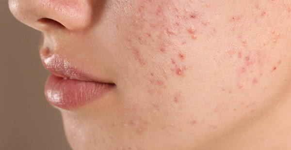 Prevents Acne and Breakouts