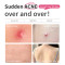 Skin Care Targeted Anti Acne Remover Acne Scar Treatment Serum Removal Face Serum