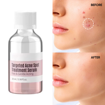 Skin Care Targeted Anti Acne Remover Acne Scar Treatment Serum Removal Face Serum