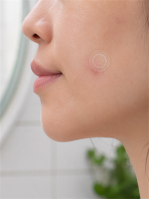 Client receiving a micro-needling treatment while the practitioner holds a serum vial