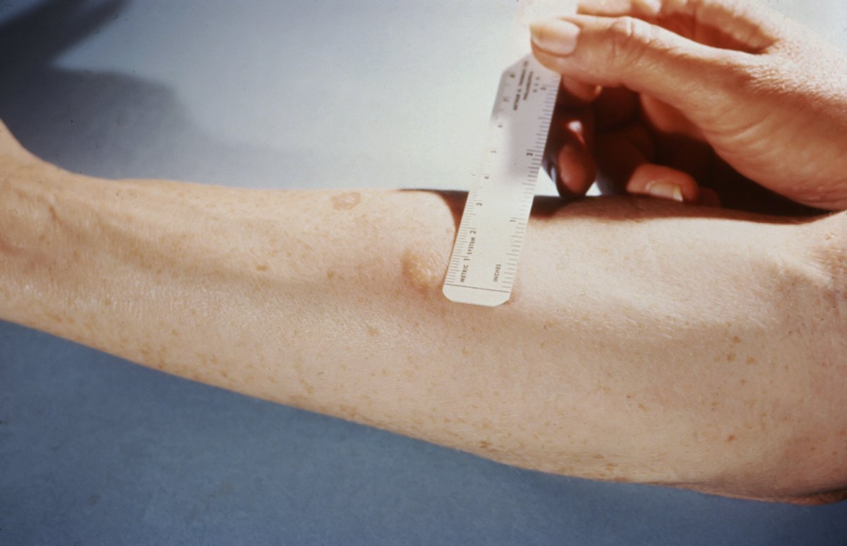 Skin sensitivity / allergy test illustration